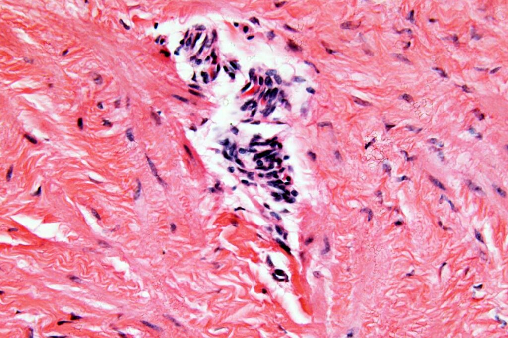 Unpicking endometriosis reveals how it affects more than the pelvis